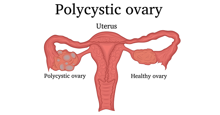 illustration of polycystic ovary and uterus